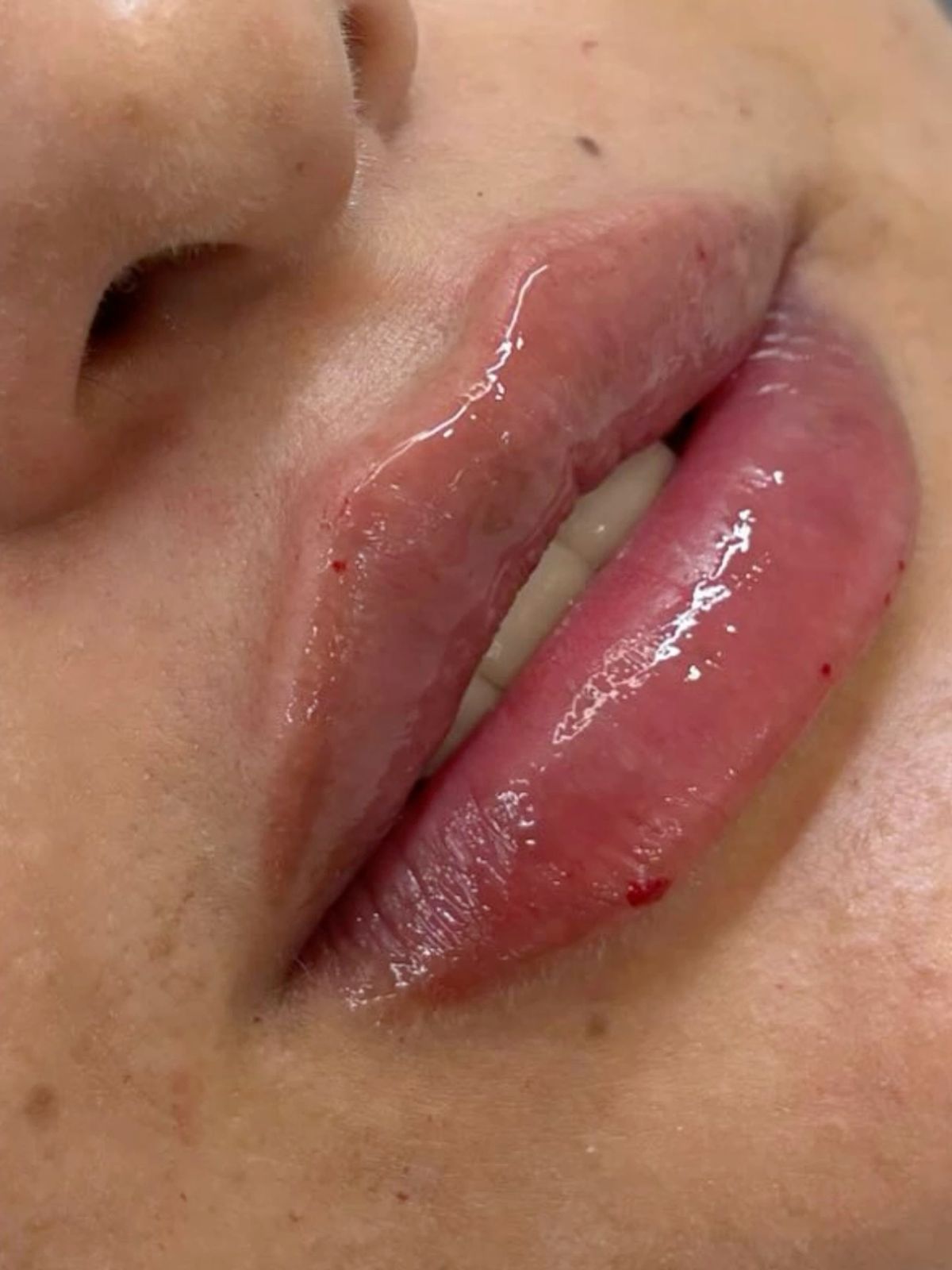 Lip filler hyaluronic acid injection cosmetic enhancement